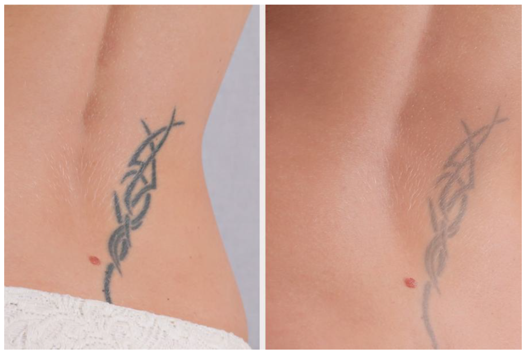 eliminación de tatuajes